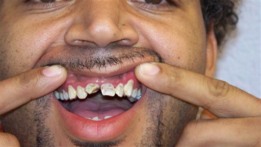 Tenn Jail Teeth Injured
