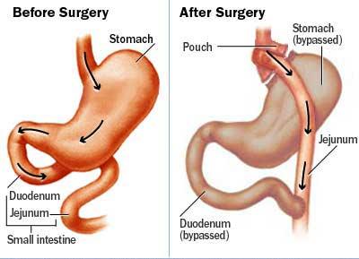 Gastric-Bypass2